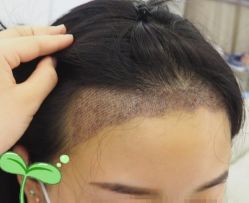 -大麦微针植发丨全国连锁