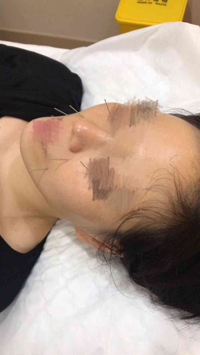 打分 眼睛特别干涩,来试试眼部针灸治疗,第一次效果满意,立马在现场又