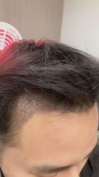 体验后-大麦微针植发全国连锁