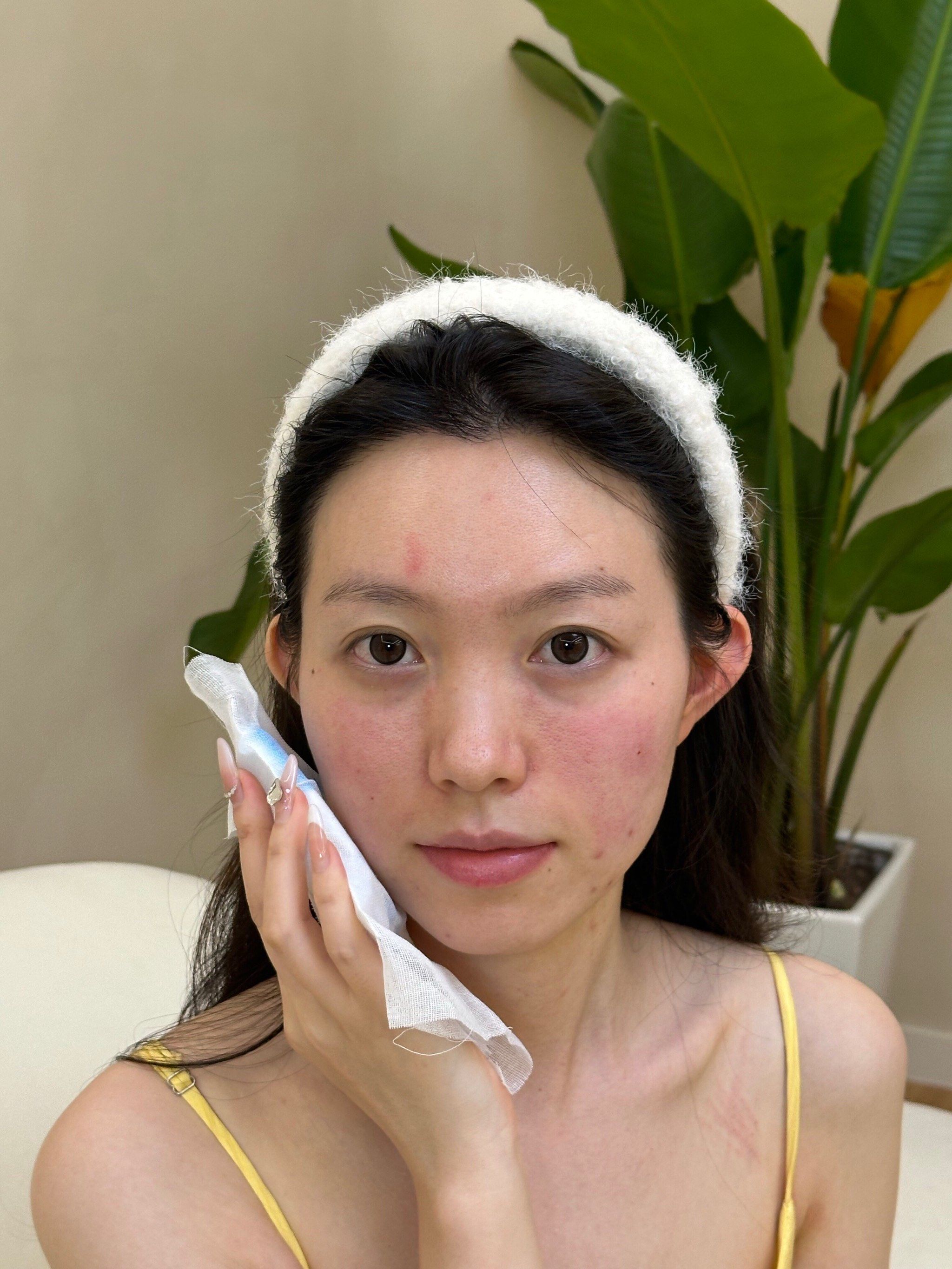 苹果肌填充,久违的少女感终于再现了