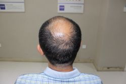 -大麦微针植发全国连锁