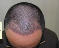 -大麦微针植发全国连锁