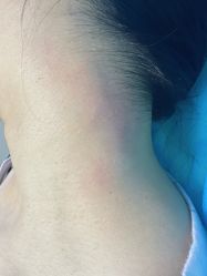 -美丽人生祛斑扁平疣汗管瘤中心
