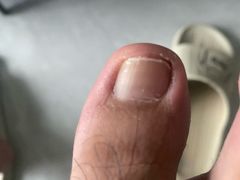 -祖传修脚甲沟炎灰指甲鸡眼