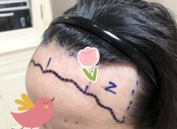 -大麦微针植发全国连锁