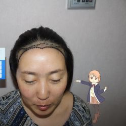 -大麦微针植发丨全国连锁