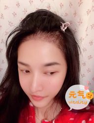 -大麦微针植发全国连锁