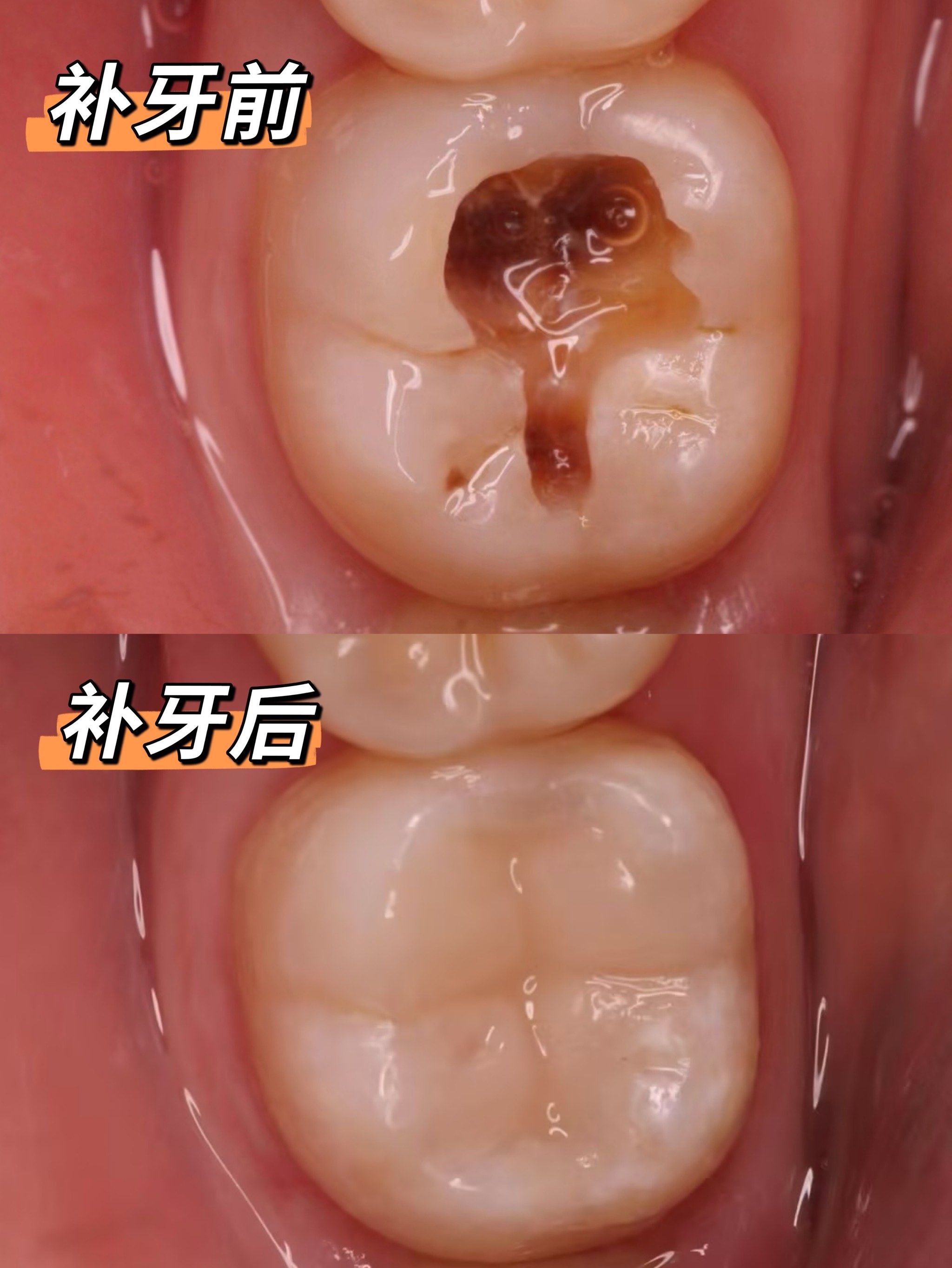 猜猜这样的补牙多少钱?