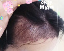 -大麦微针植发全国连锁