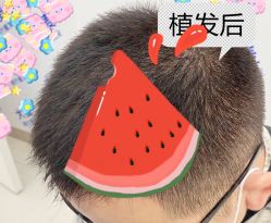 -大麦微针植发全国连锁