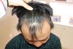 -大麦微针植发丨全国连锁