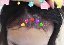 -大麦微针植发全国连锁