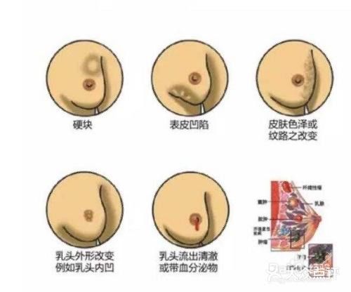 切勿长期挤乳沟 小心乳腺增生