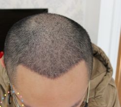 -大麦微针植发丨全国连锁