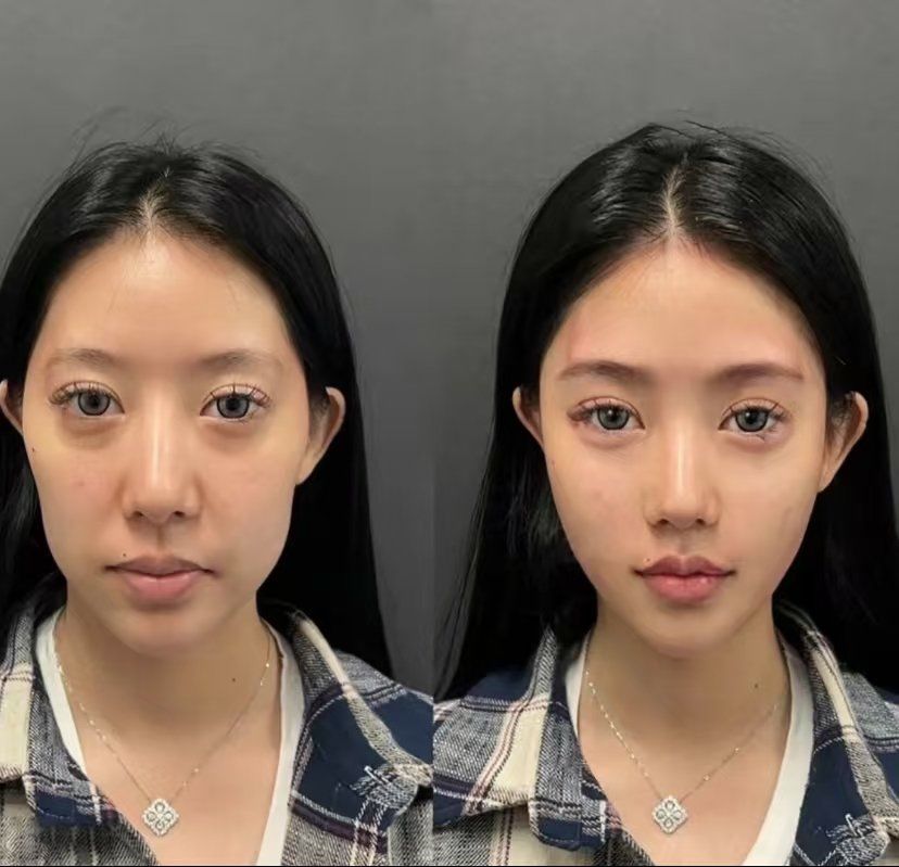 我是颧骨颧弓高,显得脸型不好看,有缘在网上看到了友谊医院的案例,都
