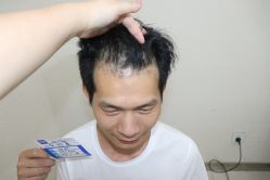 -大麦微针植发丨全国连锁