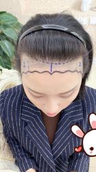 -大麦微针植发丨全国连锁