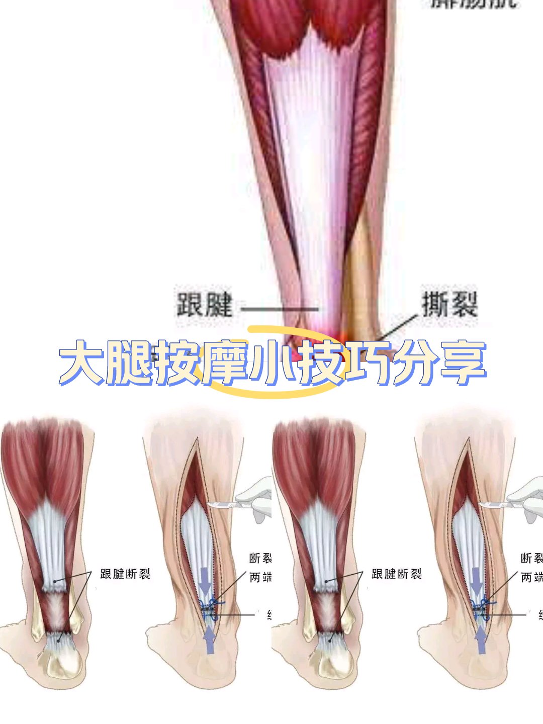 沃尔跟腱图片