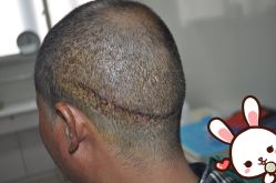 点击看大图 -大麦微针植发丨全国连锁