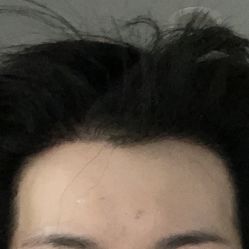 点击看大图 -大麦微针植发丨全国连锁