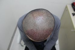 点击看大图 -大麦微针植发丨全国连锁