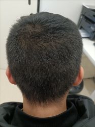 点击看大图 -大麦微针植发丨全国连锁