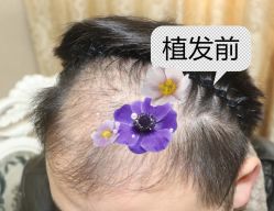 -大麦微针植发全国连锁