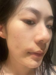 体验前-北京英煌医疗美容