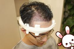 -大麦微针植发丨全国连锁