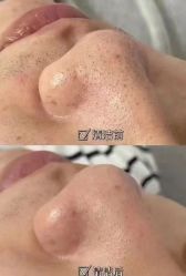 -塑青春&伊肤泉祛痘皮肤管理