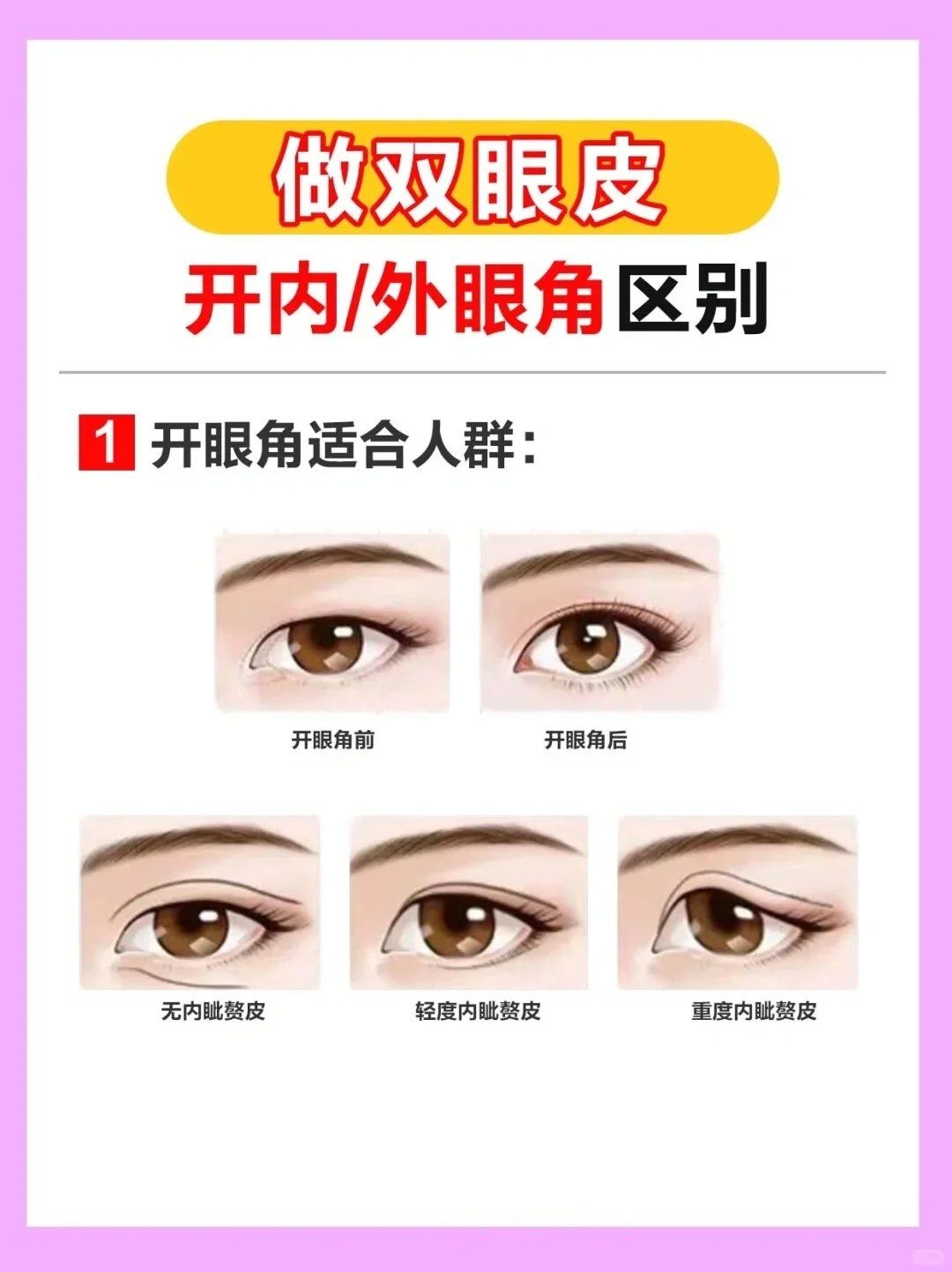 轻度内眦赘皮可以选择开一点.2.眼距比较窄