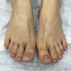 点击看大图 -德哥灰指甲脚气甲沟炎跖疣护理