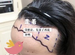 -大麦微针植发全国连锁