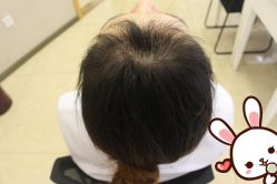 -大麦微针植发丨全国连锁