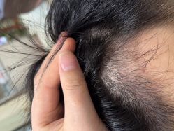 点击看大图 -碧莲盛·不剃发植发