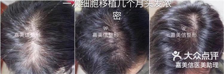头发移植成功率有多高