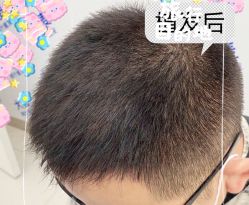 -大麦微针植发全国连锁