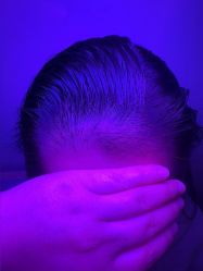 -大麦微针植发丨全国连锁