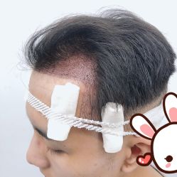 -大麦微针植发丨全国连锁