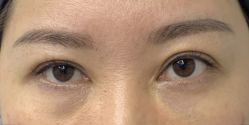 体验前-广州健丽·去眼袋医疗美容机构