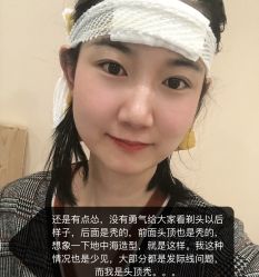 -碧莲盛·不剃发植发