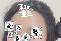 -大麦微针植发全国连锁