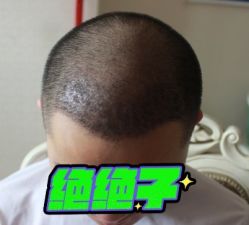 -大麦微针植发丨全国连锁