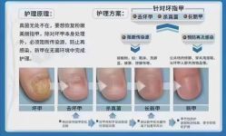 -德哥灰指甲脚气甲沟炎跖疣护理