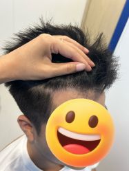 -大麦微针植发全国连锁