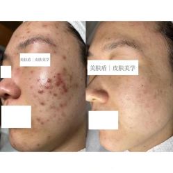 -美肤盾祛痘·问题肌头疗管理中心