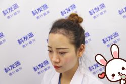 -大麦微针植发丨全国连锁