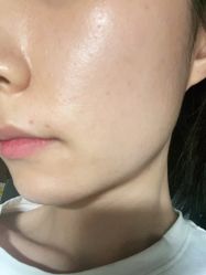 体验后-小忠丽格医美