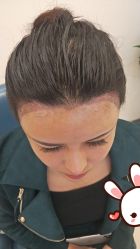 -大麦微针植发丨全国连锁