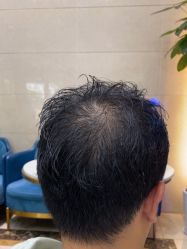 -碧莲盛·不剃发植发